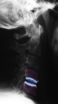 Cervicalarthro5