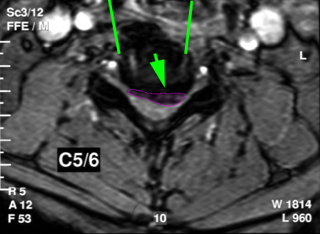 CervicalDiscectomy2png