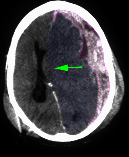 Subdural