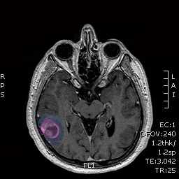 Glioblastoma