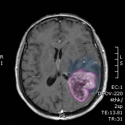 Glioblastoma3