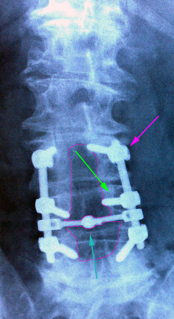 LumbarFusionDecompr3