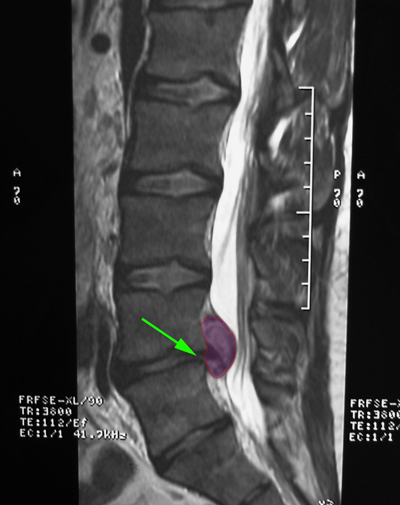 LumbarHernia4