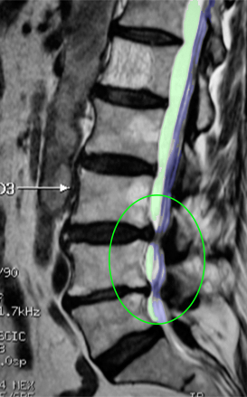 LumbarStenosis3