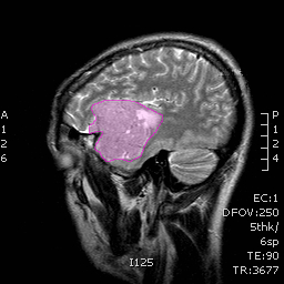 Meningioma3