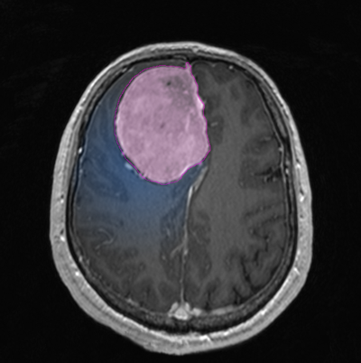 Meningiomarev