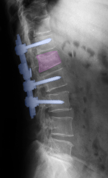 LumbarFusionFracture