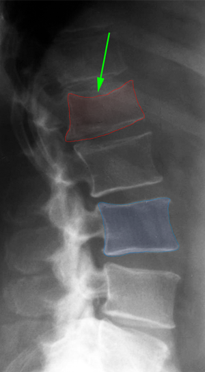 Spinalfracture1
