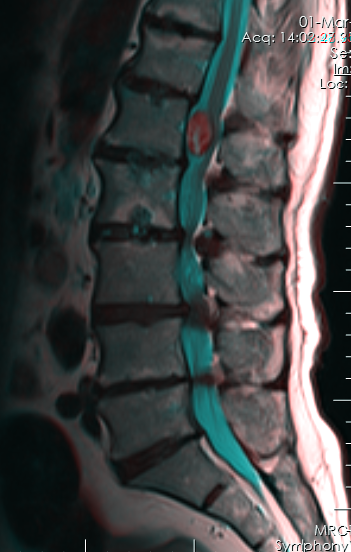 SpinalTumor