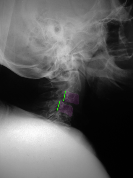CervicalSpondylolisthesis