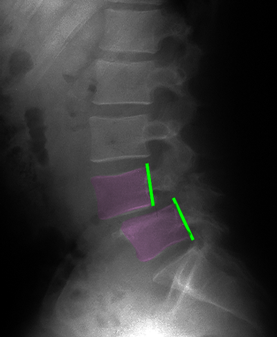 Spondylolisthesis