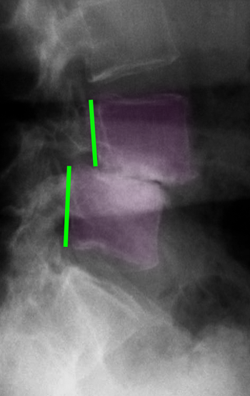 Spondylolisthesis3